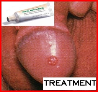 Genital Herpes Test herpes oral.